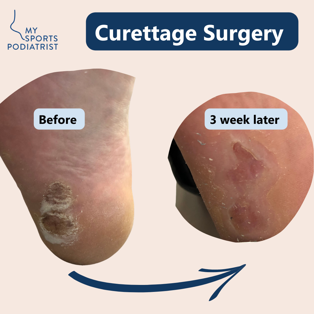 surgical-treatment-for-plantar-warts